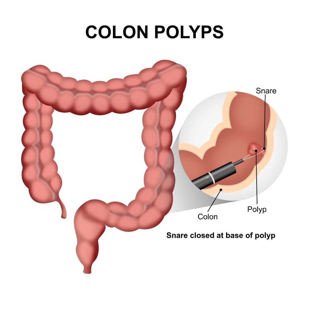 colorectal cancer screening without symptoms Singapore.