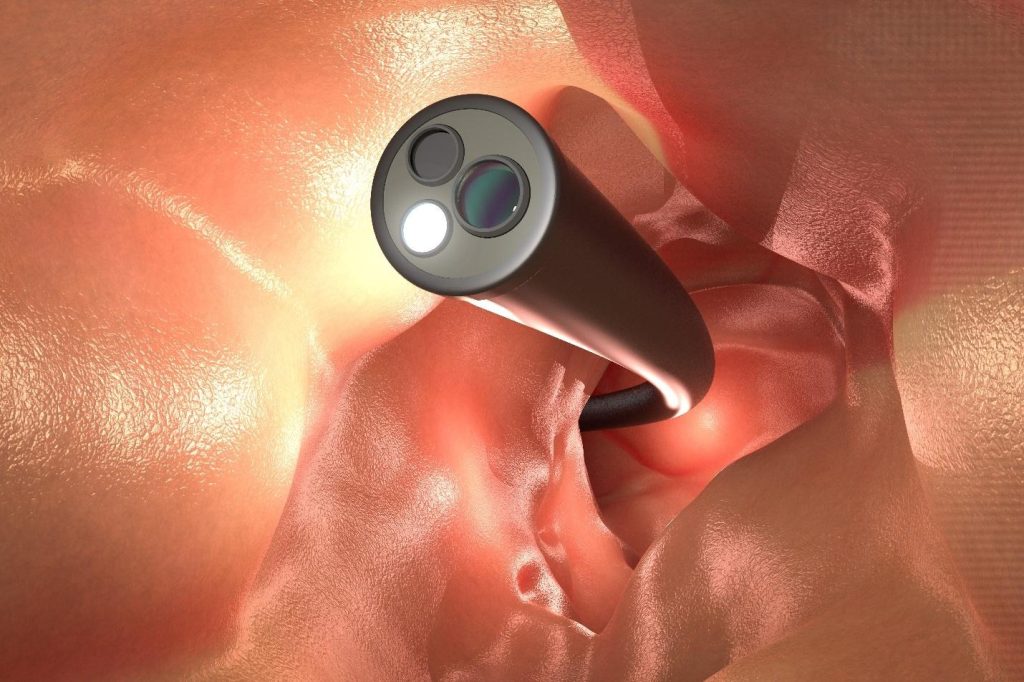 common colonoscopy myths in Singapore.