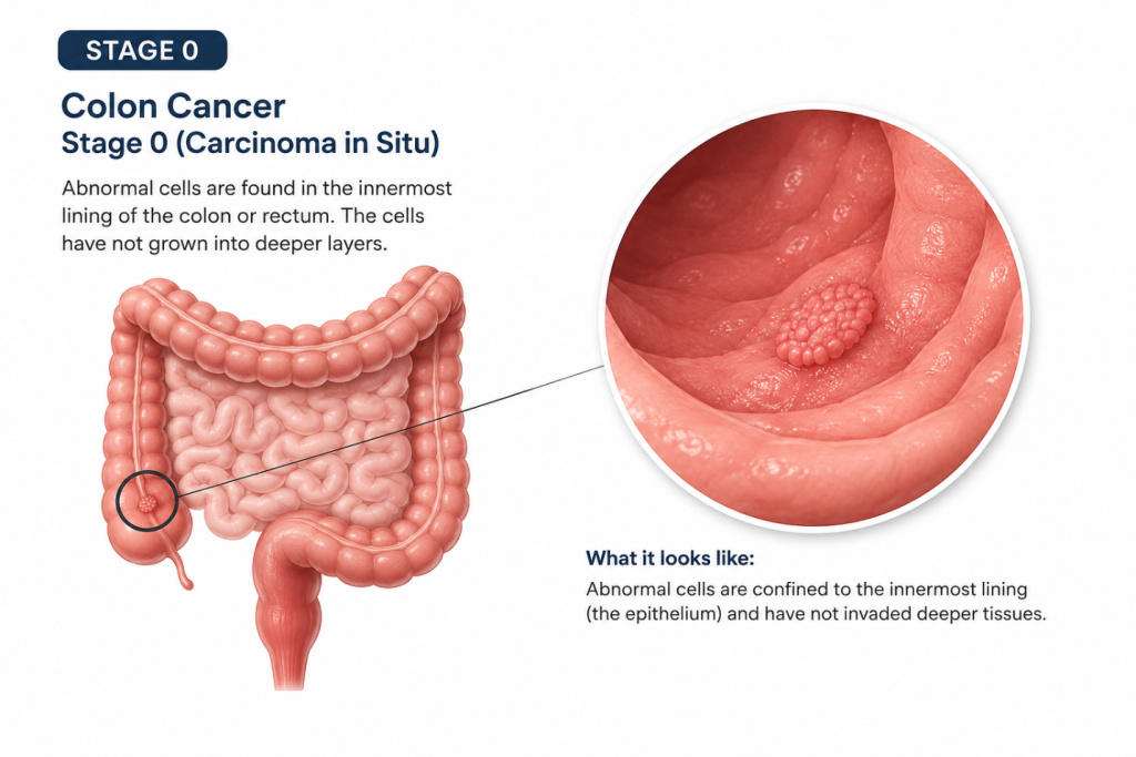 Stage 0 colorectal cancer explained.