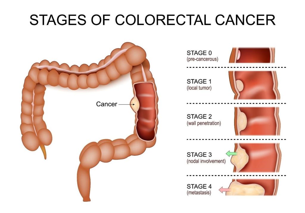 stages of colorectal cancer explained from Stage 0 to Stage 4.