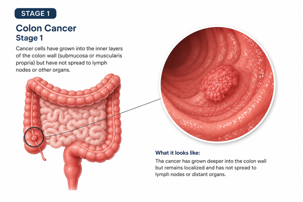 stage 1 colorectal cancer explained.