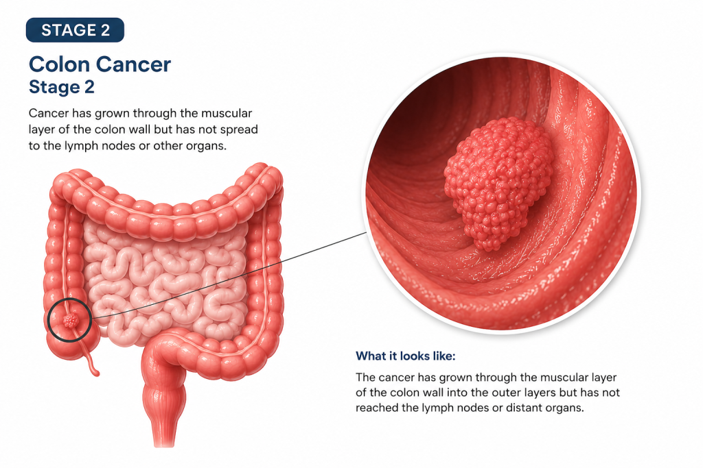 stage 2 colorectal cancer explained.