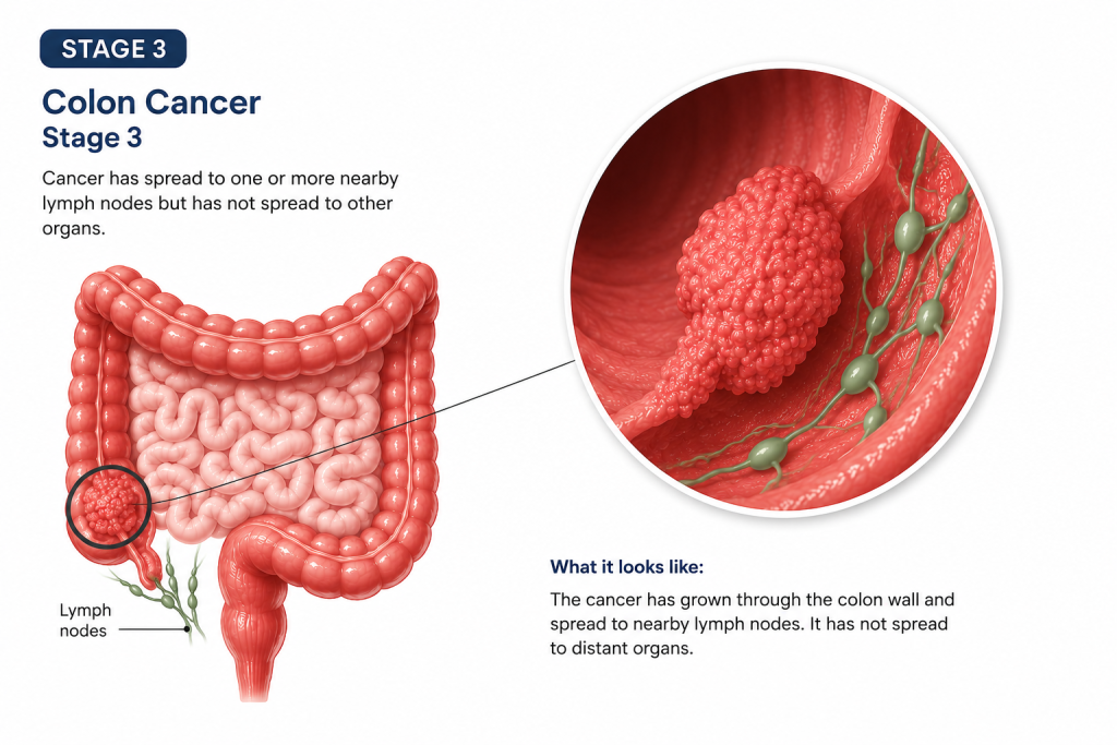 stage 3 colorectal cancer lymph nodes.