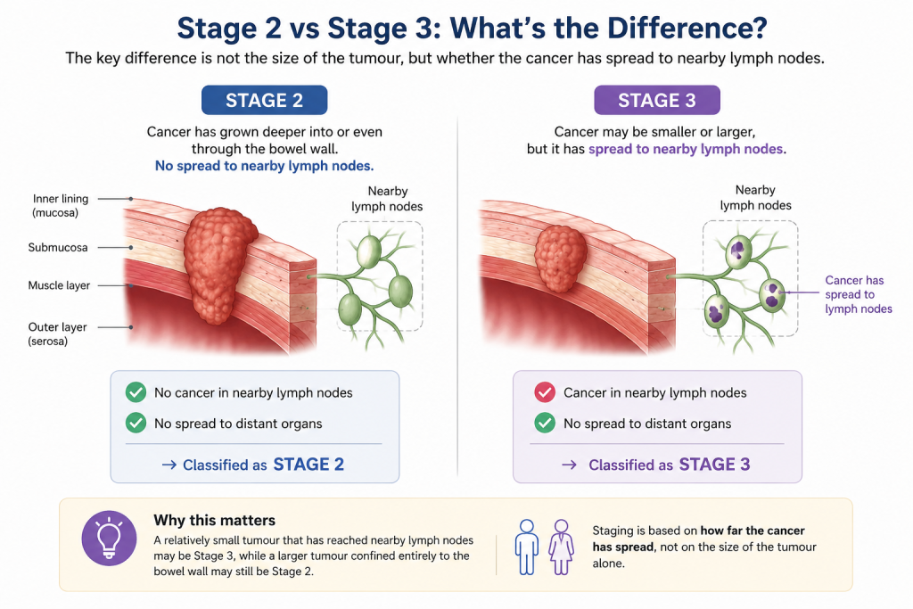Medical illustration comparing Stage 2 and Stage 3 colorectal cancer.