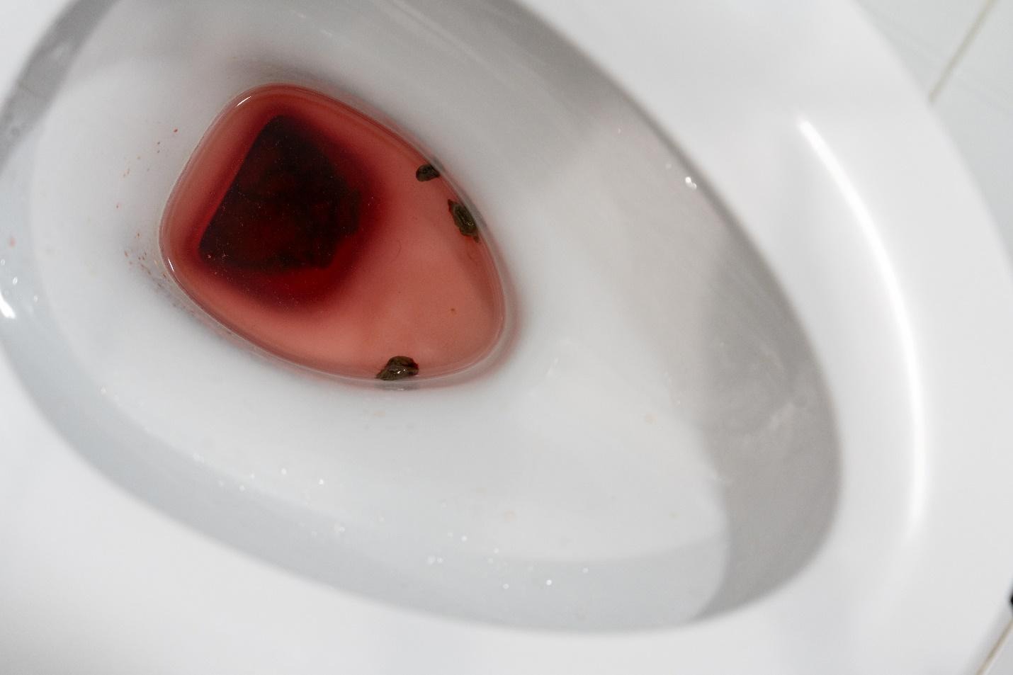 different patterns of blood in stool and rectal bleeding.